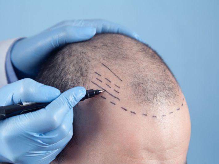 هل هناك طريقة لزراعة الشعر في المنزل؟