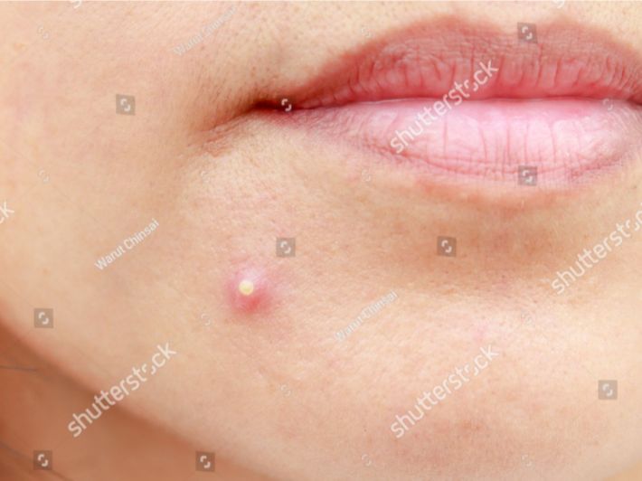 علاج الحبوب الهرمونية في الذقن