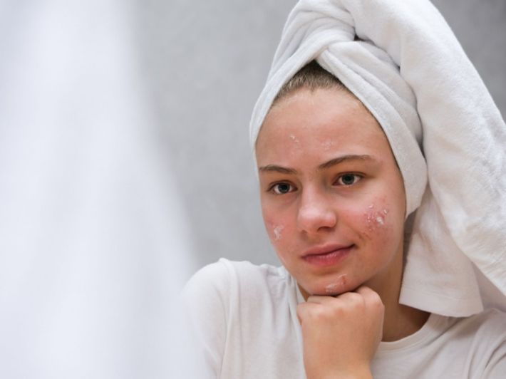 كل ما تحتاج معرفته حول بنزاك جل لحب الشباب