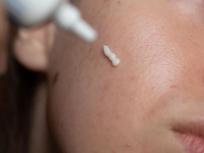 ما هي فوائد كريم أدابالين في علاج حب الشباب؟