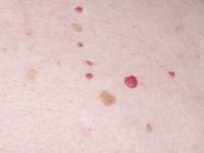 Small Red Moles: Are They Dangerous?