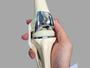 Knee Replacement Surgery: Procedure, Recovery, and More!