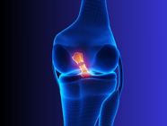 ACL Surgery: What You Need to Know