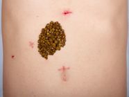 Laparoscopic Gallbladder Surgery: A Patient Guide