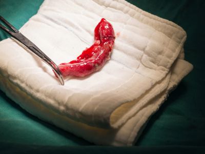 Laparoscopic Appendectomy: What You Need to Know