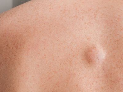Removing a Lipoma Without Surgery: Is It Possible?