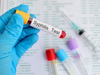 Syphilis in Men: 7 Common Questions and Answers