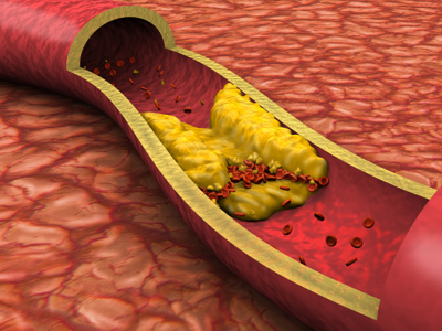 Pioneering Cardiac Care: The Heart Center at Al-Ahli Hospital Achieves Outstanding Results in a Complex Coronary Procedure