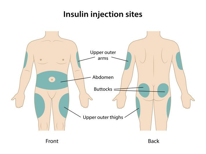 How To Give A Diabetic Injection