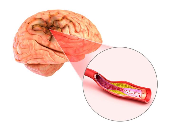 السكتة الدماغية عند كبار السن