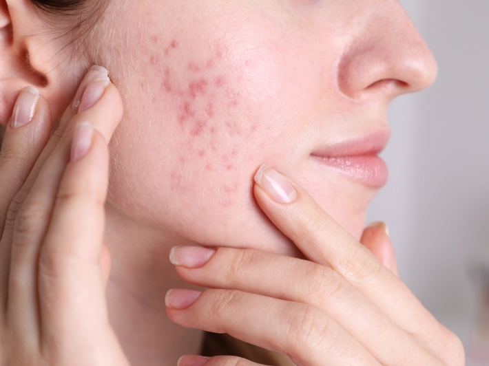 Acne Scar Removal Malaysia