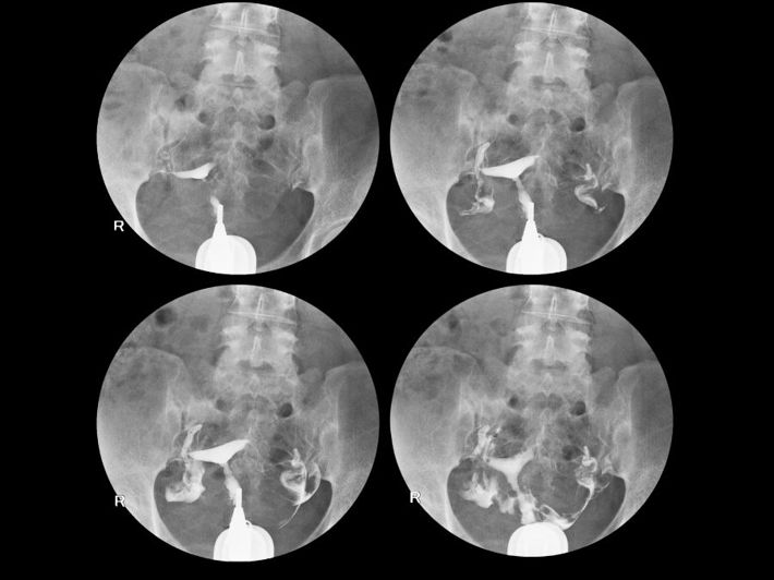 Hysterosalpingography (HSG): 5 Common Questions and Answers