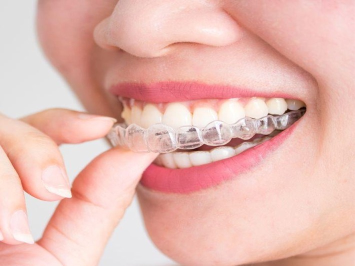 Types of Dental Braces