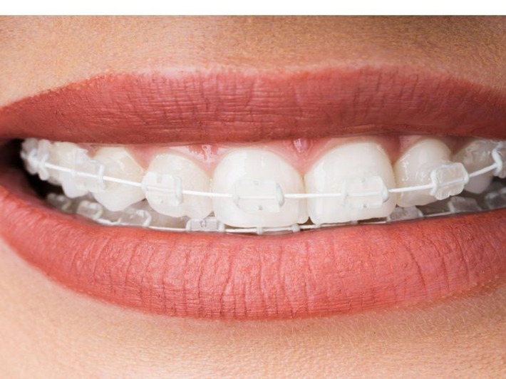 Types of Dental Braces