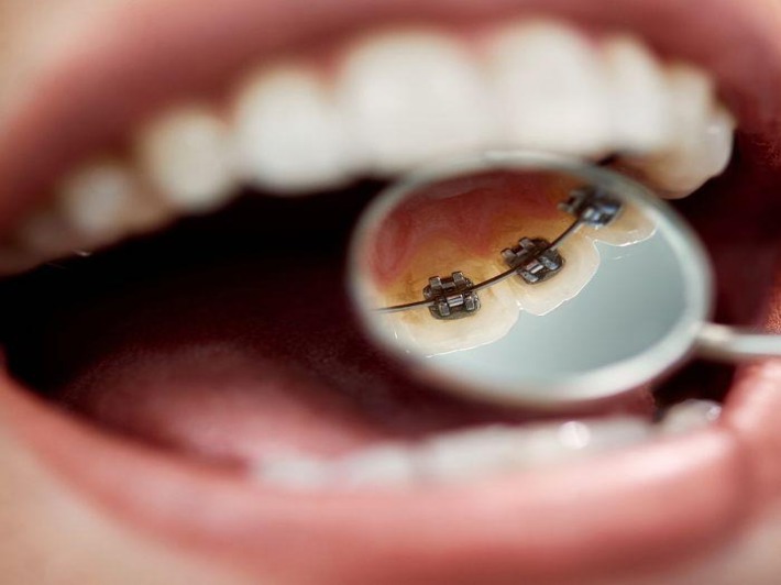 Types of Dental Braces