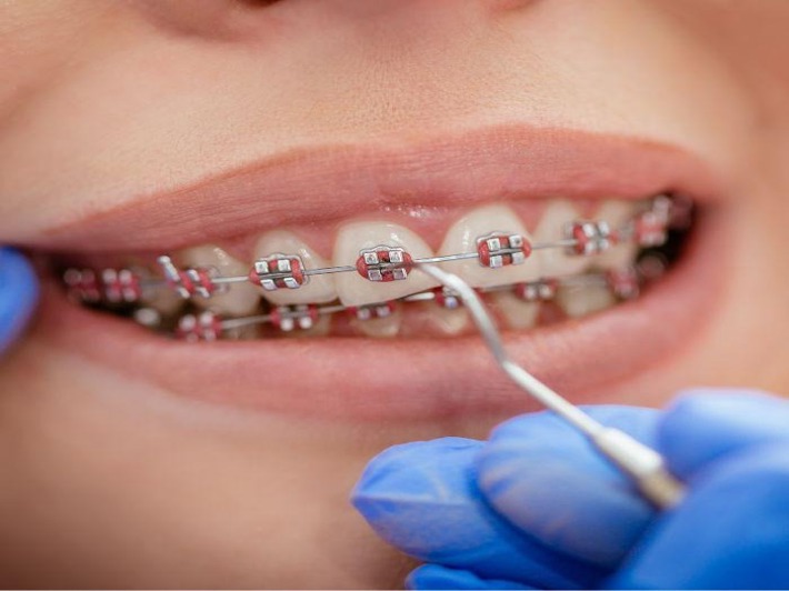 Types of Dental Braces