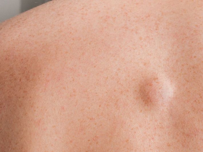 Removing a Lipoma Without Surgery: Is It Possible?