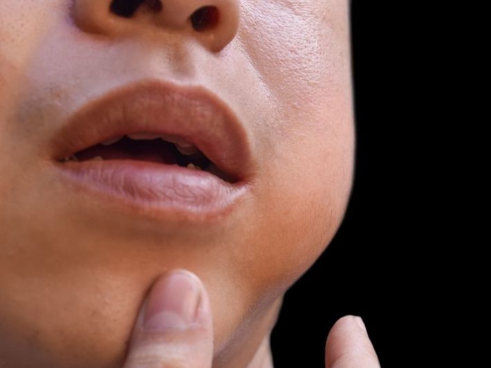 Mumps (Parotitis): Answering Your Questions
