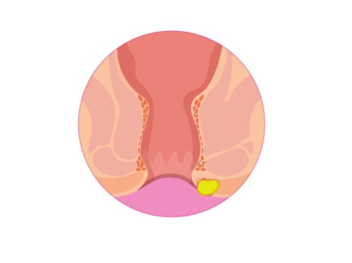 Anorectal Abscess: Causes and Treatment