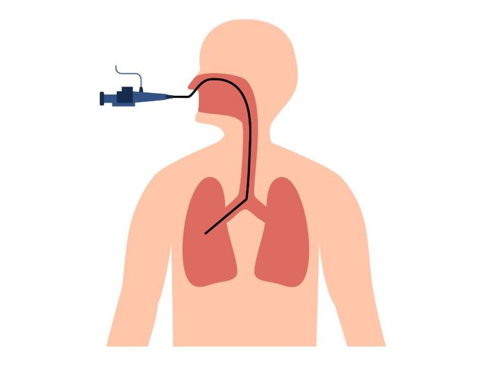Bronchoscopic Lung Biopsy: A Simple Guide