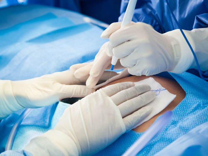 Cesarean Section Hernia: What You Need to Know from Causes to Treatment