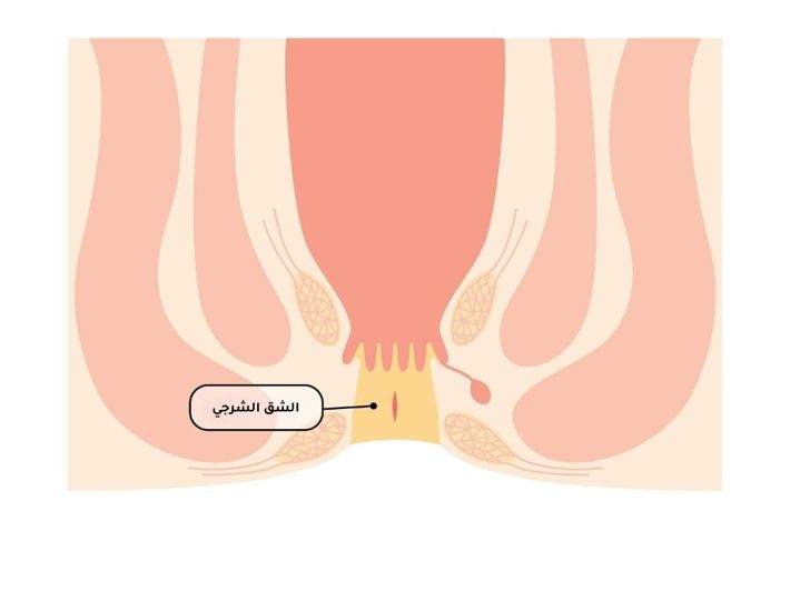How Can an Anal Fissure Be Treated?