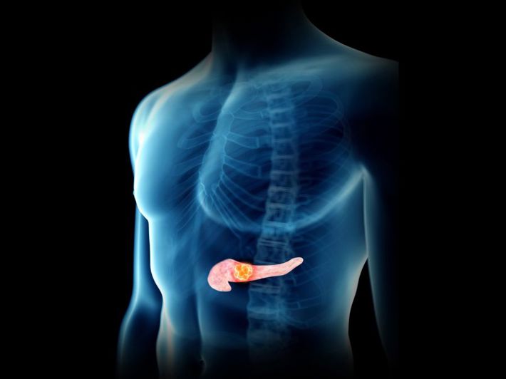 Pancreatitis: Symptoms, Causes, and Treatment