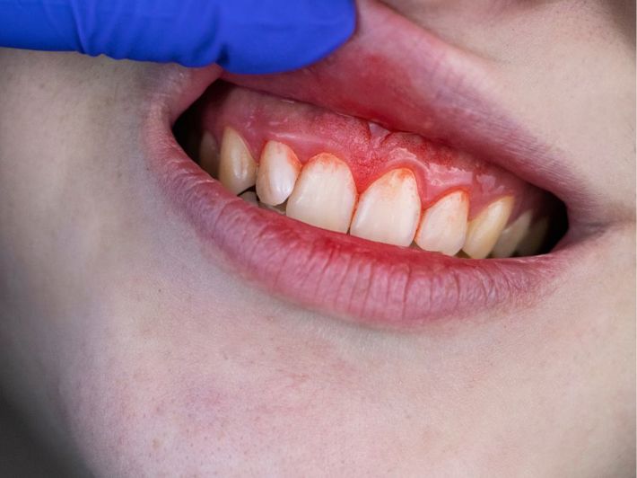 Bleeding Gums: Causes and Treatment