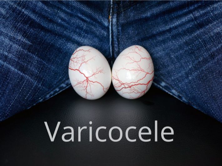 شكل دوالي الخصية