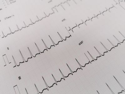 تسرع القلب فوق البطيني: الأعراض، الأسباب، الفحوصات والعلاج تسرع القلب فوق البطيني: الأعراض، الأسباب، الفحوصات والعلاج