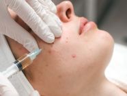 ظهور حبوب بعد حقن الفيلر