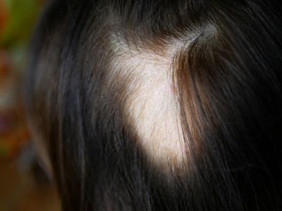 أعراض وعلامات الثعلبة، وهل تحتاج دائماً إلى علاج؟