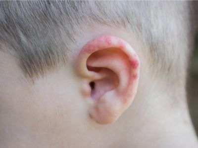 إكزيما الأذن: الأعراض، الأسباب والعلاج