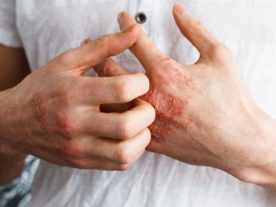 الحساسية الجلدية: الأعراض، الأسباب والعلاج