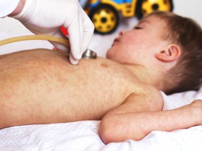الحصبة الألمانية: الأعراض، الأسباب والعلاج