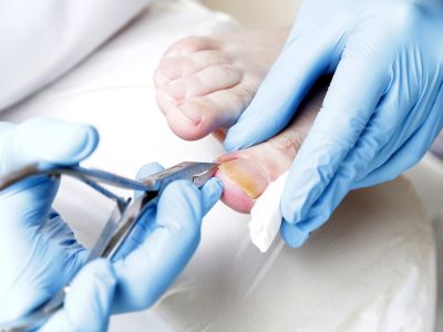 الظفر الناشب: الأعراض، الأسباب والعلاج