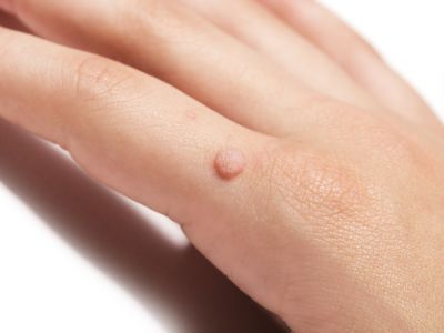الفرق بين الهربس والثآليل التناسلية
