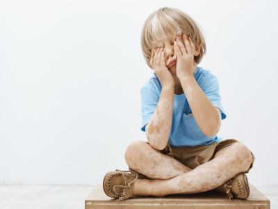تشخيص البهاق عند الأطفال