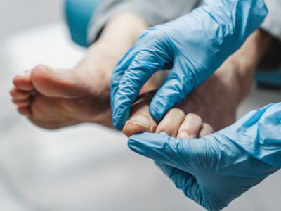 طرق الوقاية من مرض سعفة القدم