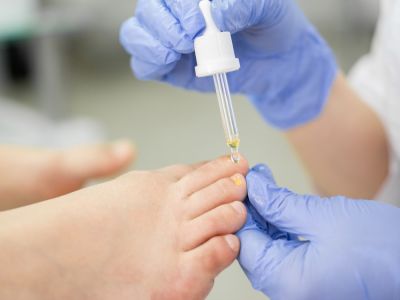 طرق علاج فطريات الأظافر ومدة التعافي المتوقعة