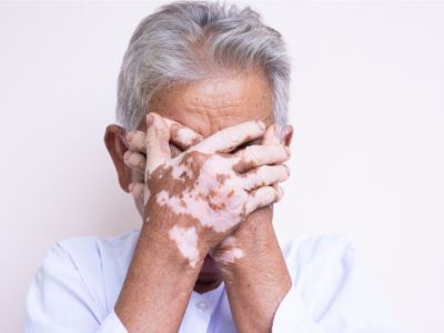 ظهور البهاق بعد الأربعين