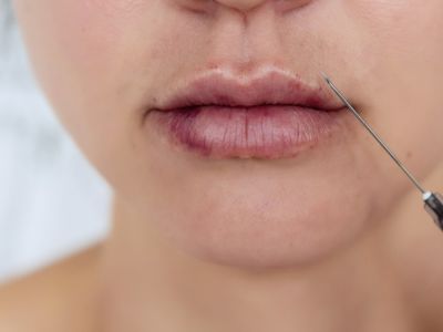 ظهور كدمات بعد حقن الفيلر: لماذا وما العمل؟