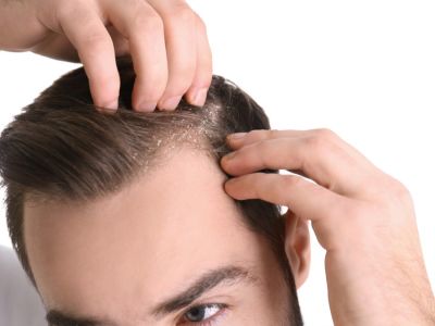 كيفية علاج الصدفية على فروة الرأس