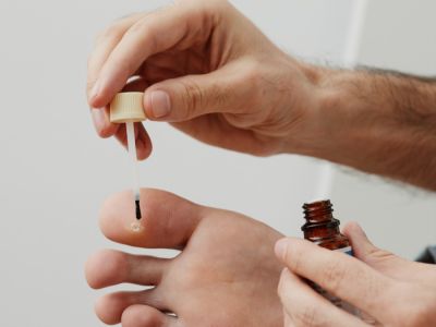 مسمار القدم: الأعراض، الأسباب والعلاج