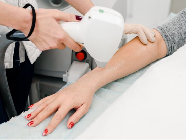 ظهور الشعر بعد جلسة الليزر الأولى