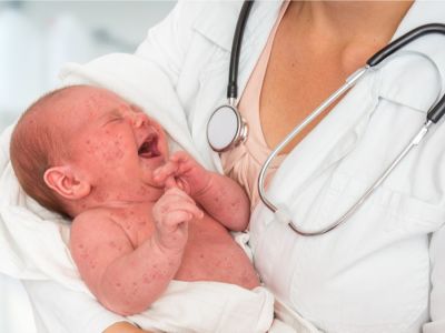 الحبوب على جسم الرضيع: الأسباب والعلاج