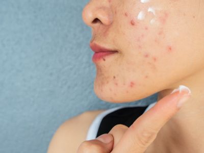 الرؤوس البيضاء: الأسباب والعلاج