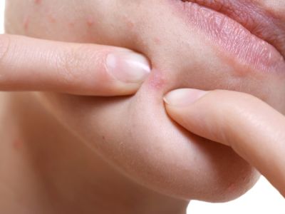 ظهور حبوب في الذقن: الأسباب والعلاج