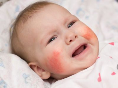 ظهور طفح في وجه الرضيع: لماذا وما العمل؟
