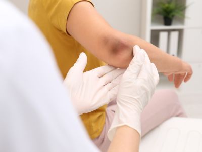 ظهور كدمات على الجسم دون سبب: لماذا وما العمل؟